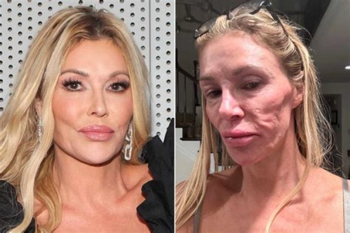 Brandi Glanville Denies Plastic Surgery After Infection
