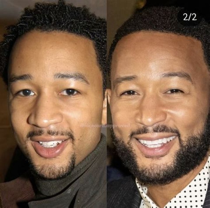 John Legend plastic surgery