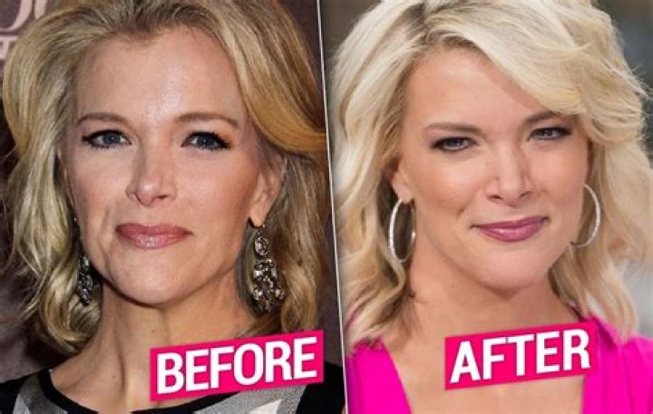 Megyn Kelly Facelift – Did She Get Plastic Surgery? Before And After Pics And Age